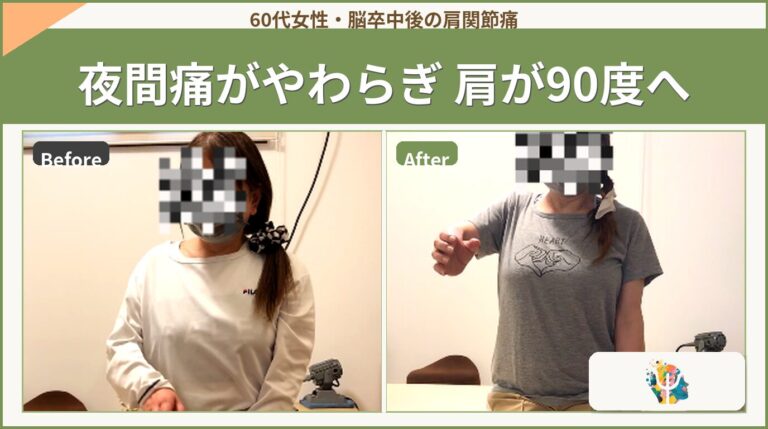 脳卒中後の肩の痛みと亜脱臼をどう見るか｜夜間痛がやわらいだ一例から考える