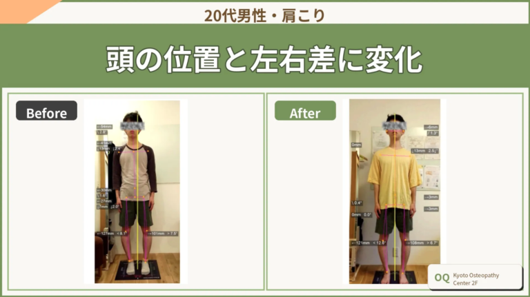 肩こりを「肩だけ」で見ない理由｜頭の位置と身体全体のつながり