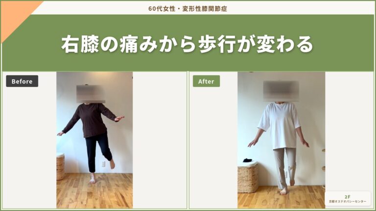 右膝をかばって歩く60代女性の一例——股関節との連動から見た変化