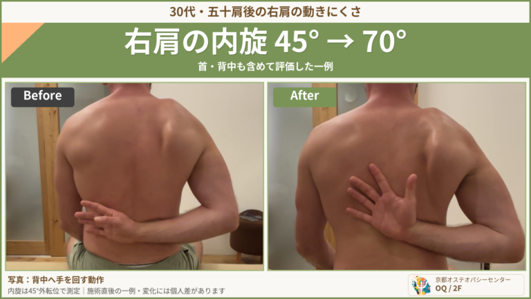 肩甲骨まわりを緩めても残る違和感。首と肩を分けて見直した一例